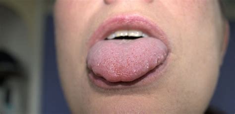 bolinhas na lingua